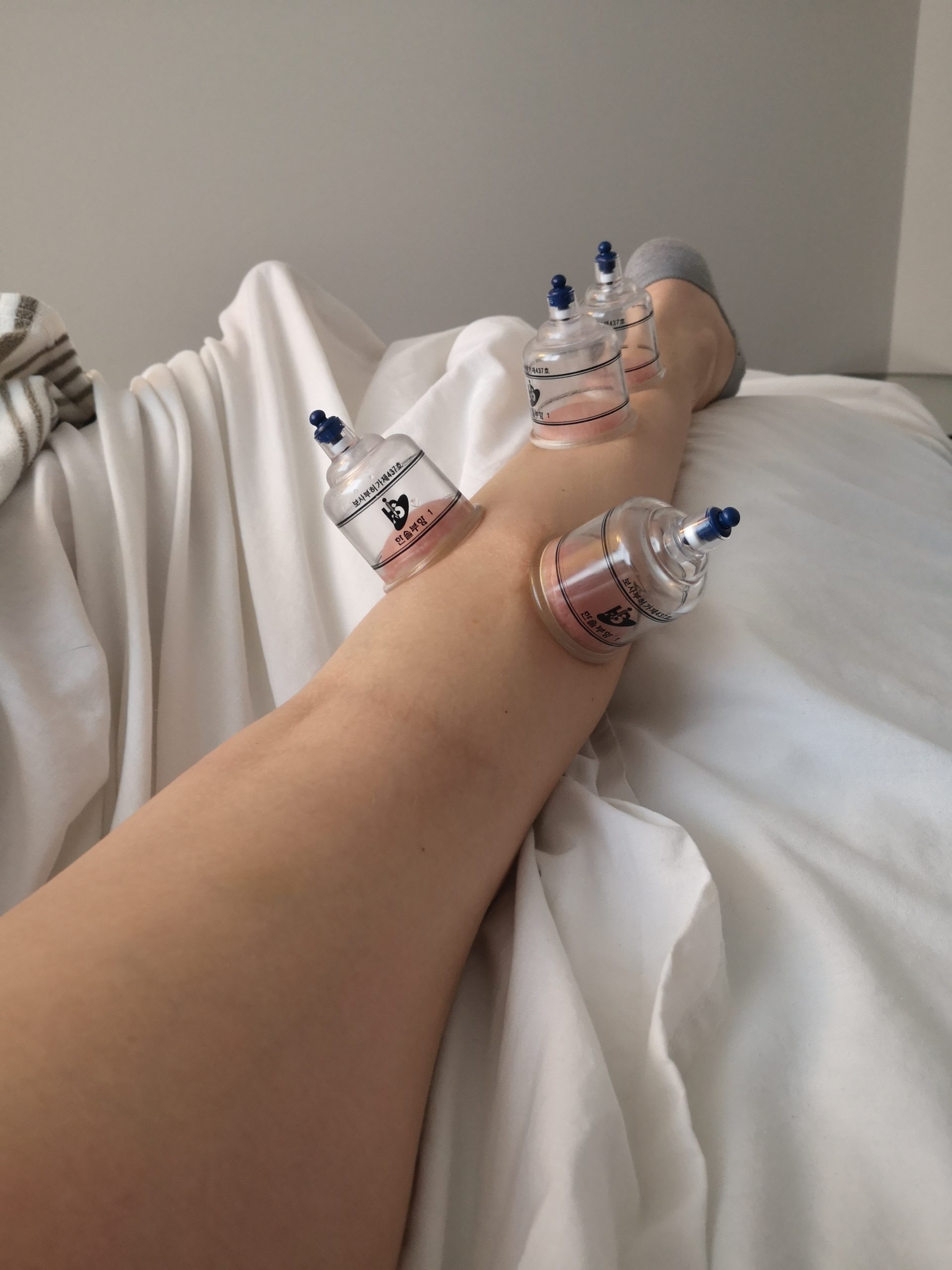 Cupping on calf